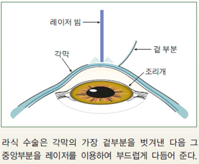 레이저를이용한각막수술 - 눈의광학적파워 : 초점거리의역수 (m), 단위 : 디옵터초점거리가짧은렌즈 : 빛이많이꺾임 >> 초점거리짧아짐 >> 디옵터큼 -