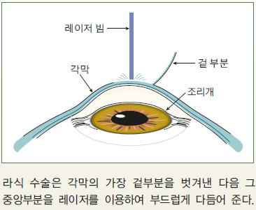 레이저를이용한각막수술 - 눈의광학적파워 : 초점거리의역수 (m), 단위 : 디옵터초점거리가짧은렌즈 : 빛이많이꺾임 >> 초점거리짧아짐 >> 디옵터큼 -