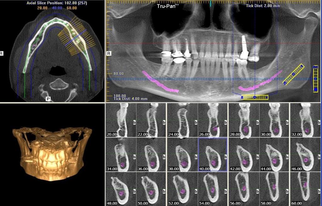 Scan, CT Intraoral