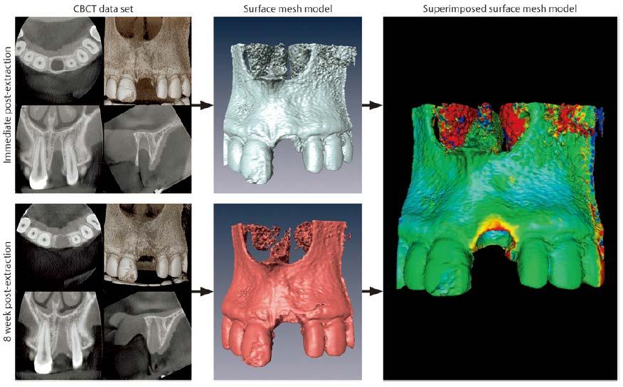 Three-dimensional (3D) alterations of facial bone in the esthetic