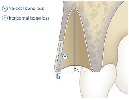 bone resorption