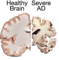 1-c. 뉴로스템 NEUROSTEM NEUROSTEM : 알츠하이머및경도인지장애자 (Mild Cognitive