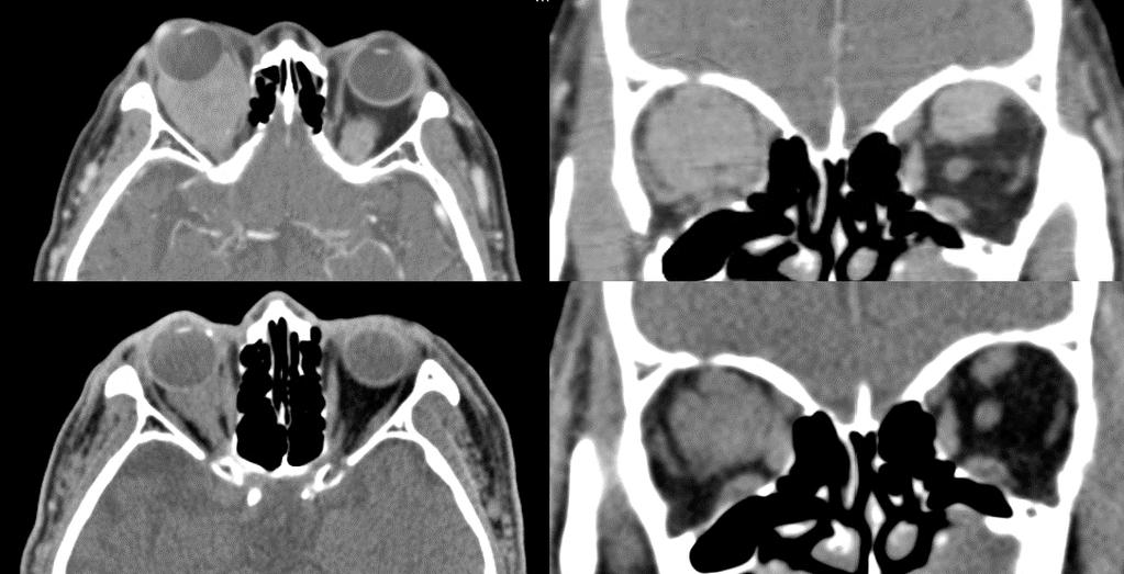 - 대한안과학회지 2017 년제 58 권제 12 호 - A B Figure 3. The patient's computed tomography (CT) images. (A) The axial and coronal views of the CT show approximately 3.