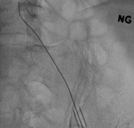 (A) Fluoroscopy reveals the fractured guidewire in the kinked drain catheter (white arrow).