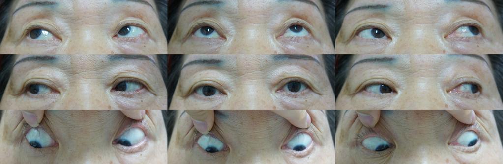 - 검안및콘택트렌즈학회지 2017 년제 16 권제 4 호 - Figure 4. By 2 months postoperatively, the patient had complete resolution of the ptosis and eye movement limitation. 적증상이호전되었던사례가보고된바있다.