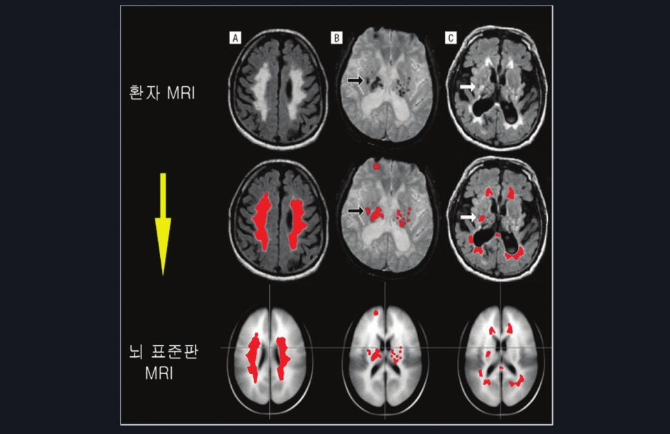 CHAPTER 01 들어가기 3 환자 MRI 뇌표준판 MRI 그림 1 3 ImageQNA 소프트웨어를이용해뇌 MR 영상에서관찰되는뇌백질변성병변을분할분할 (2 행사진의빨간색 ) 후뇌표준판에정합 (3 행사진의빨간색 ) 시키는방법에관한개요도.