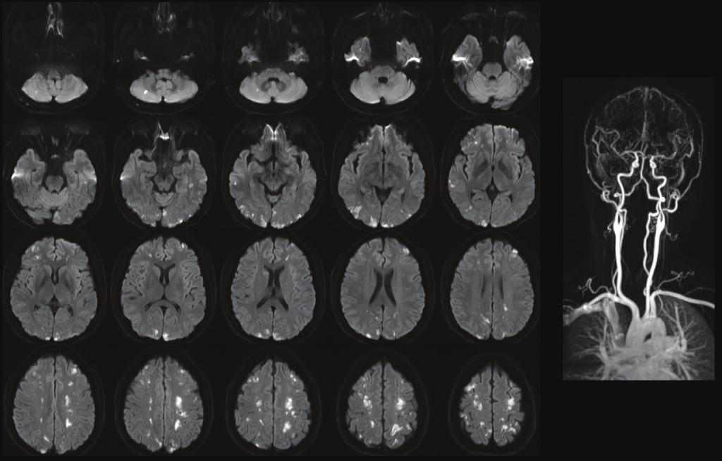 26 뇌졸중 MRI 의이해와정량분석 : 매트랩을이용한참조표준 / 뇌지도제작 그림 3 3 뇌전반에걸쳐관찰되는여러개의급성허혈성뇌경색병변.