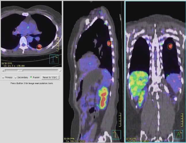 그림 13 18. 그림 13 은 Fusion PET (PET/CT) 영상이다. 설명에관하여옳은것은?