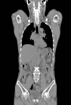 2) CT 의 X ray로인해 PET 영상의해상도저하는감안해야한다.