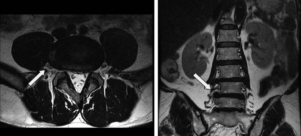추간판탈출증에서관상면의유용성 김명호외 Fig. 4. MR images of a patient shows extraforaminal disc herniation of L4~L5. (A) T2 axial image shows deviation of Rt.