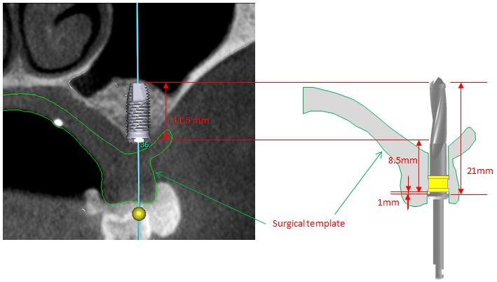 Surgical template 의원리 앞서, implant planning software 를이용하여 implant 의식립위치를계획할경우, 이에맞게 surgical template 가제작됩니다. 여기서는어떻게 drilling 의방향과깊이가 surgical template 에반영되는지설명합니다. 그림 7.