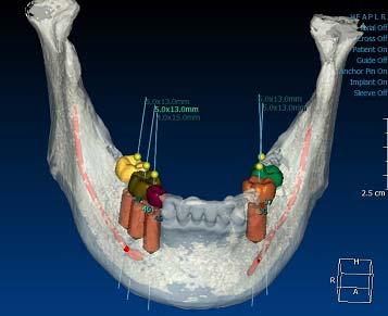 일반적으로 orthodontic splint 와비슷한형상이며, 환자에게착용시킨상태로시술합니다.