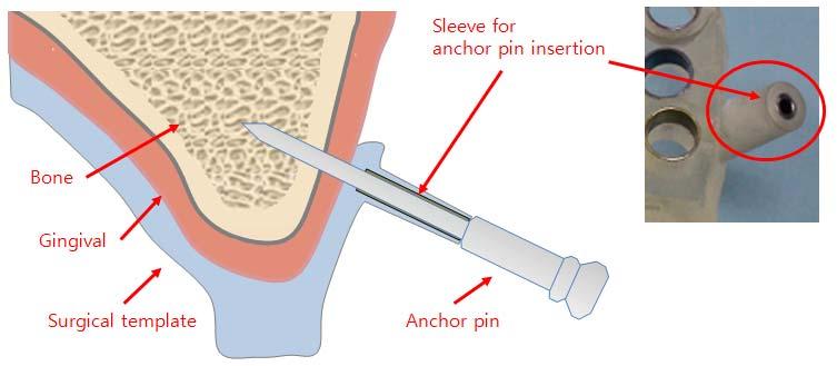 Anchor pin 은 surgical template