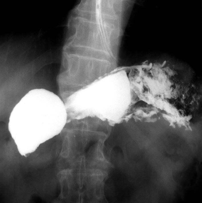 정미희 외: 새로 고안된 복합형 팽창성 나이티놀 스텐트를 이용한 악성 위 십이지장 협착의 치료 A B C D Fig. 4. Pancreatic carcinoma in a 66year-old man. A. Upper gastrointestinal study performed before stent placement shows obstruction in the second portion of the duodenum.