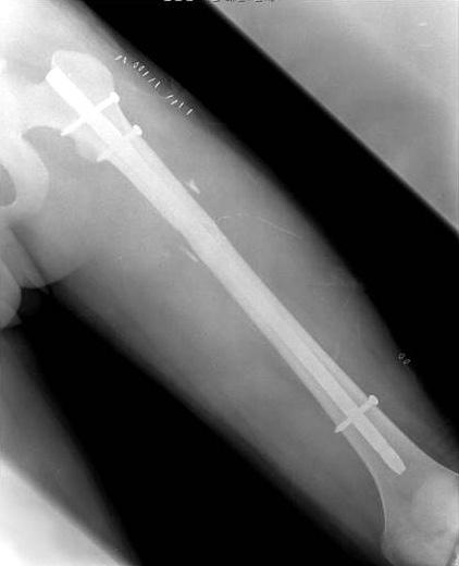 (B) Postoperative radiograph of the femur after intramedullary nailing. Figure 2.
