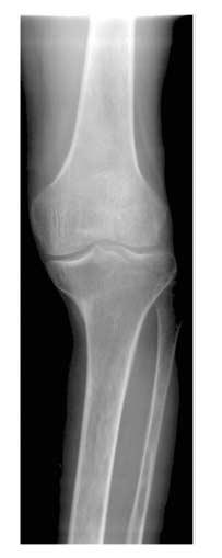 무릎의퇴행성관절염 2 교정절골술 ( 그림 5)