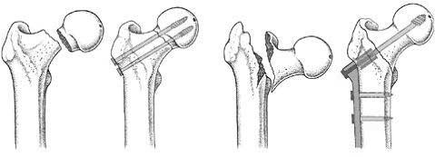 흔히보는고관절질환 뼈를붙이는수술 인공관절수술 4.