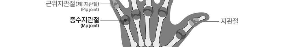 부터심장에서먼쪽으로손가락뼈의일부가절단된경우를말하며, 뼈단면이불규칙해진상태나손가락길이의단축없이골편만떨어진상태는해당하지않는다.