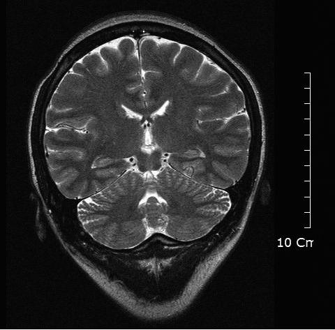 기질적병변을감별하기위하여시행한뇌 MRI 에서병변은없었고 (Fig. 1) 뇌파와척수액에서도이상소견이없었으며혈액검사에서도대사이상을의심할소견은없었다.
