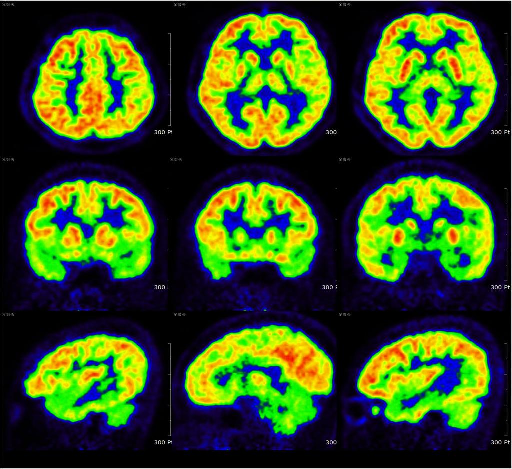 진선임 박기형 성영희 이영배 박현미 신동진 Figure 2. Brain PET scan of the patient. PET scans revealed mild decreased metabolism in the bilateral temporoparietal cortices.