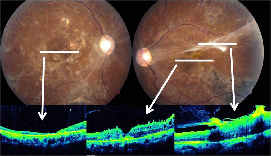 - 김시범외 : 루프스관련혈관폐쇄성망막병증 - A B C D E Figure 4. Final ocular findings of the right (A and C) and left (B, D and E) eyes.