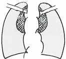 폐울혈 bulla, bleb 폐의혈관음영이증대되어있는상태이다.