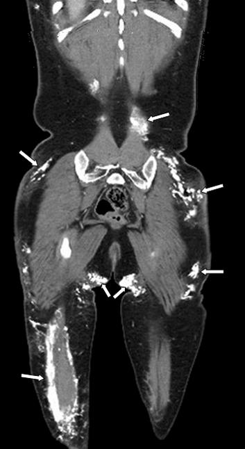 김보라외 : 괴사성혈관염후발생한석회화 Fig. 3. Computed tomography images show diffuse subcutaneous and muscular calcifications (arrows) in the both arms (A), buttock and lower legs (B).