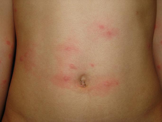 그림 3. 환자의피부증상사진 ( 인근대학병원피부과제공 ) 질병관리본부국립동해검역소 G지소에서 2008년 7월