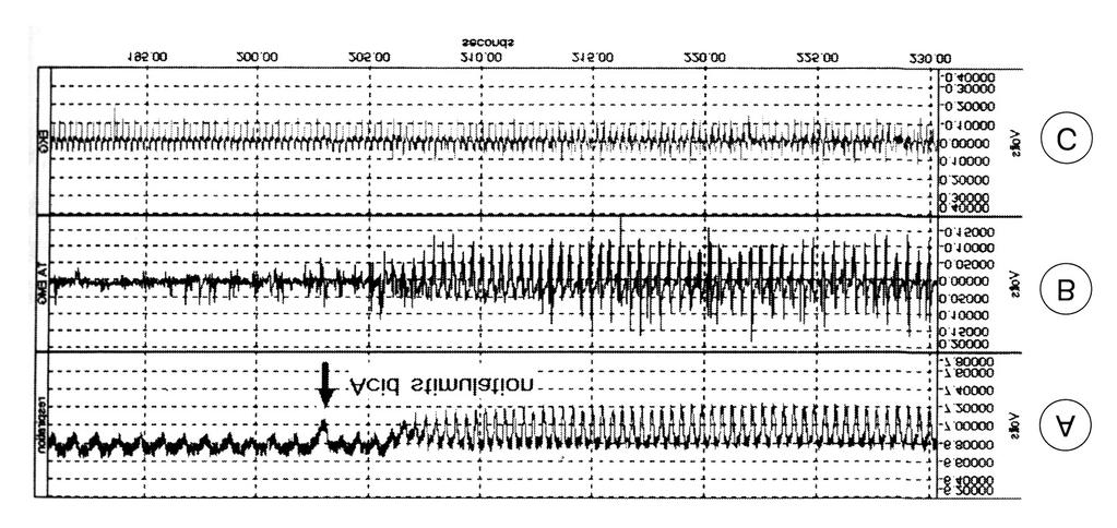 Fig. 2. Polygraph tracing of responses to acid at ph 1.0 in a case of 2 weeks of age.