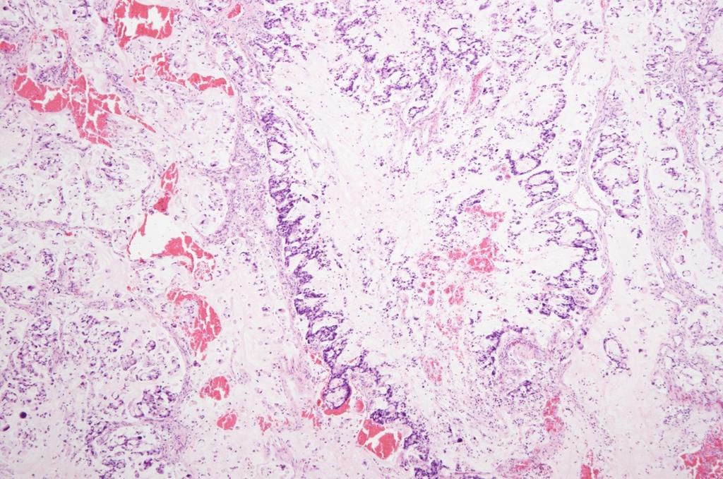 Yeon Ju Kim, et al. Metastatic adenocarcinoma of the pleura from the exocervix (cytokeratin 7) 양성, TTF (thyroid transcription factor)-1에 음 에서 이상 소견은 관찰되지 않았다. 성인 전이성 선암종이 관찰되었다(Fig. 4).