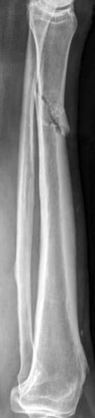 (B) Postoperative radiographs showing well maintained alignment with intramedullary nailing. (C) Interlocking screw breakage and valgus angulation at 4 months postoperatively.