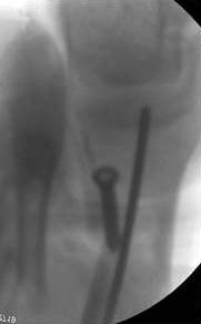 243 Locking Screw in Intramedullary Nail of Distal Tibial