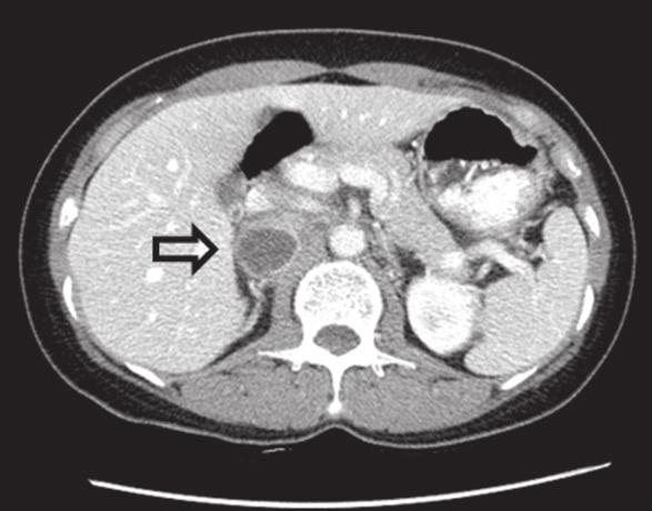 2 3 cm-sized round, lobulated mass with internal cystic change (arrow) adjacent to the right kidney. & C. Post 4 hour and 1 day after I-123 MIG injection.