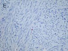 There were no over expression of p53 (immunohistochemical stain, X400).