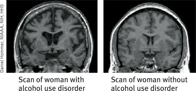 중독과뇌 두뇌비교 알코올사용장애자의뇌 일반사용자의뇌