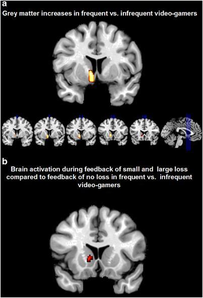 중독과뇌 게임을더많이한청소년 ( 일주일에 9 시간이상 ) 의뇌는왼쪽줄무늬체가훨씬커져있었다. 이부위는쾌락을요구하는보상중추로마약중독에빠지면커지는것으로알려져있다. S Kühn et al.