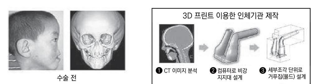 제 1 장 3D 프린팅의료기기 그림 1-8 환자수술전후사진 ( 왼쪽 ), 기도지지체제작과정 ( 오른쪽 ) 출처 : http://ims.postech.ac.