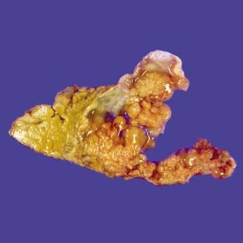 (Case 2) A computed tomographic scan shows solid masses in the dilated intrahepatic bile ducts (arrow). Fig. 3.