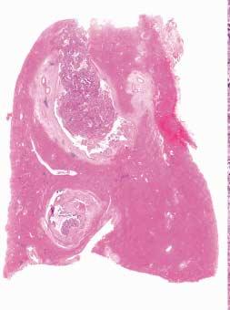 (B) The tumor penetrates the bile duct wall and invades to the liver parenchyma.