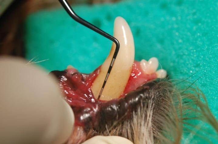 치아의 어떤 방향으로든 치관 아래의 절반 이하로 치주 탐침이 걸쳐질 때 존재한다.