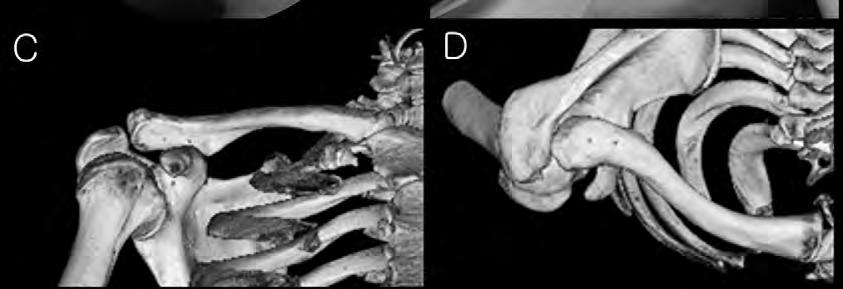 결론 관절경 하 Multiple all-suture anchor 를 이용한 오구-쇄골 고정 방법의 원칙은 multiple 한 작은 직경의 tunnel 을 만들어 native tissue 의 damage 를 최소화 하여 healing 을 빠르게 하고, 수술 중, 후 골절의 위험을 낮추는 것이다.