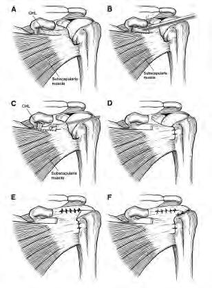 송현석 : Subscapularis (Anterosuperior Cuff Tear): A/S Interval Slide-in-continuity - the soft tissue overlying the posterolateral aspect of the coracoid tip and coracoid neck is excised.