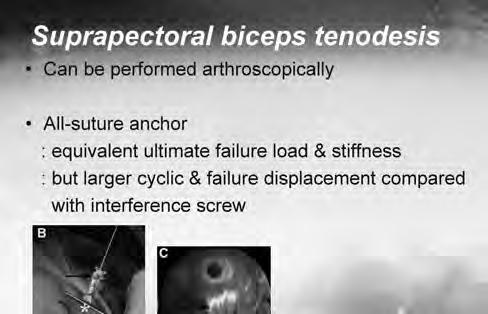 Arthroscopic Biceps Tenodesis: