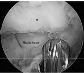 제 6 회 관절경 수술 심포지엄 (ISAKOS Approved Advanced Course) During posterolateral radiocapitellar joint débridement, remove the posterior capitellar osteophytes and assess