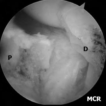 이영근 : Arthroscopic Treatment for Scaphoid Fracture or Nonunion Utica, NY, USA), 2.0 mm, 2.9 mm shaver, 3.