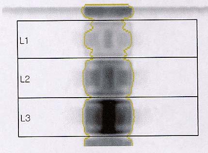 종류의밀도를가지고피질골과해면골을본떠서수산회인화석 (Hydroxyapatite)