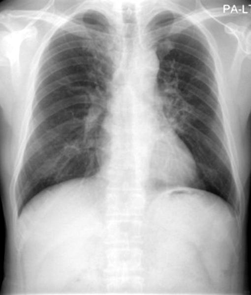 LLL with mild lung volume expansion. (B) Two months later, there is a decrease in the extent of segmental air space consolidation with peripheral ground glass attenuation in previous area.