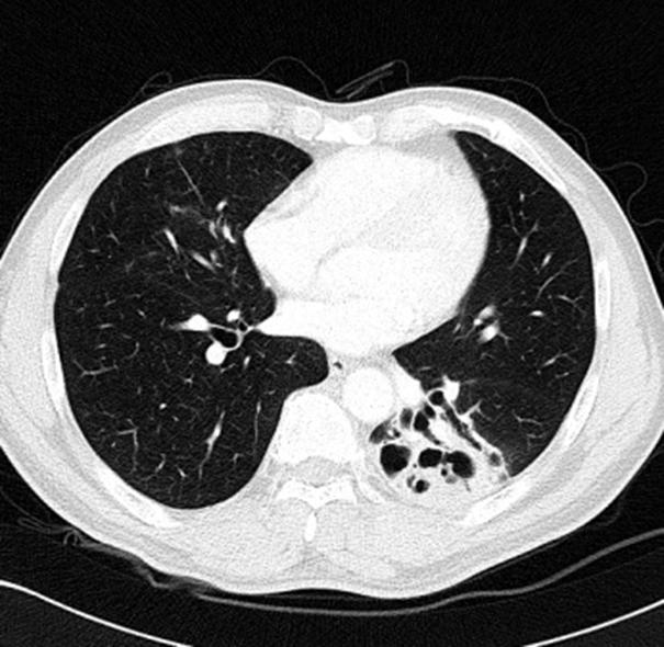 Chest CT findings Cases (n=7) No remnant lesion Ground glass opacity/consolidation Fibrostreaky density Bulla Cystic bronchiectasis 0 3 2 1 1 (0) (43) (29) (14) (14) Data are presented as