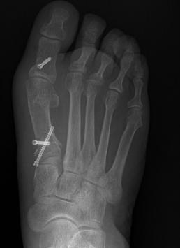(A) Hallux valgus was corrected after proximal chevron osteotomy fixed