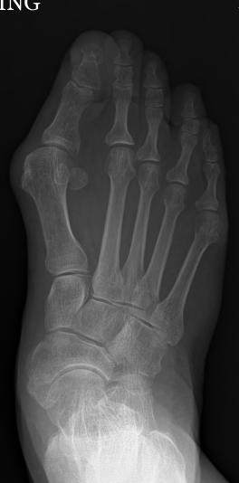 (B) Hallux valgus was corrected after proximal chevron osteotomy fixed